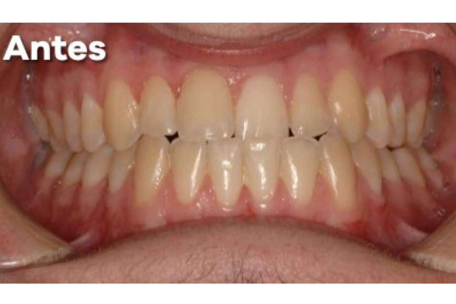  Las ventajas de los tratamientos de ortodoncia invisible, por Cleardent 