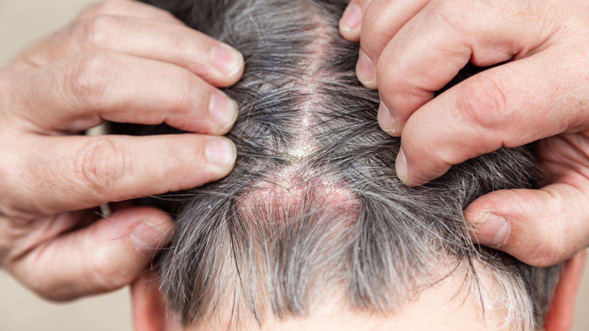 scalp-psoriasis-symptoms-causes-and-treatment