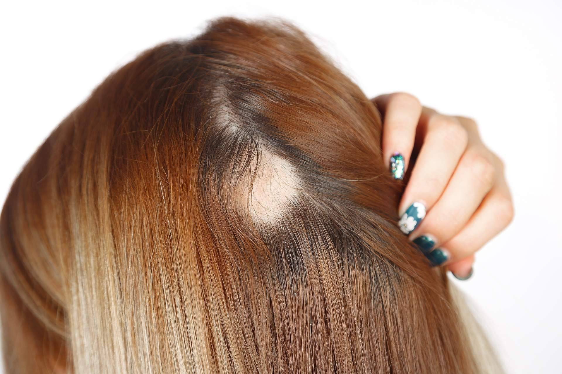  El método de Capilar Innovation Clinic para combatir la alopecia femenina 