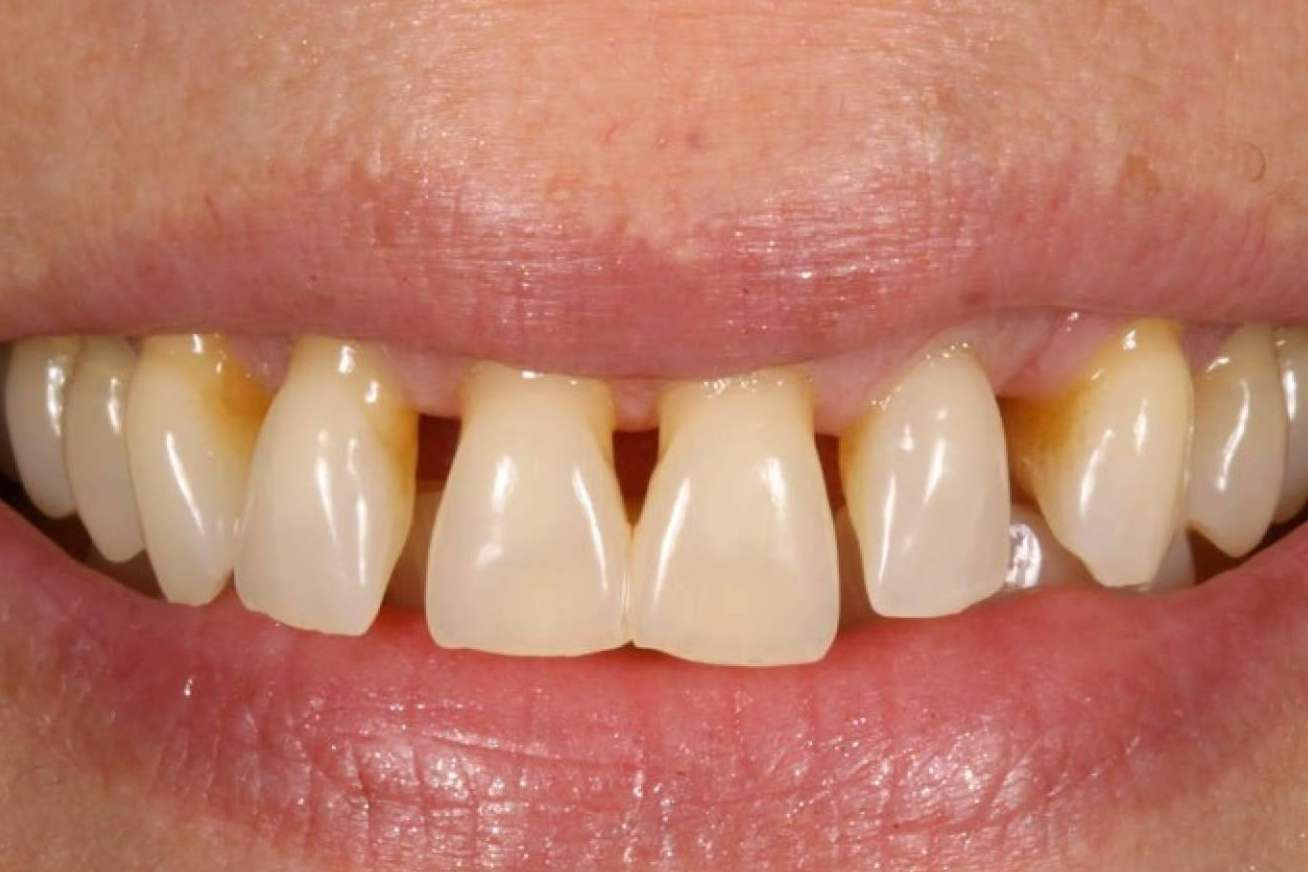  Tratamiento para la gingivitis, de la mano de Clínica Dental Ruiz de Gopegui 
