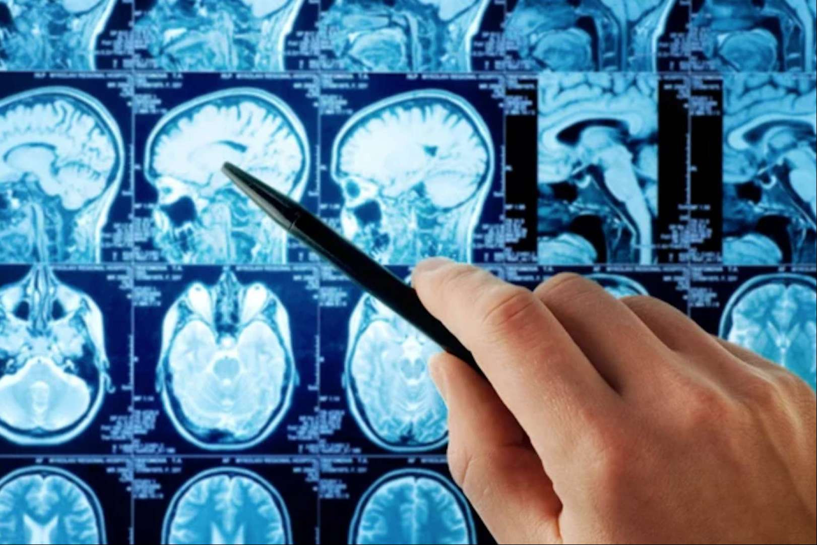  Conocer los beneficios de oncothermia en tumor cerebral (Gliomas) 