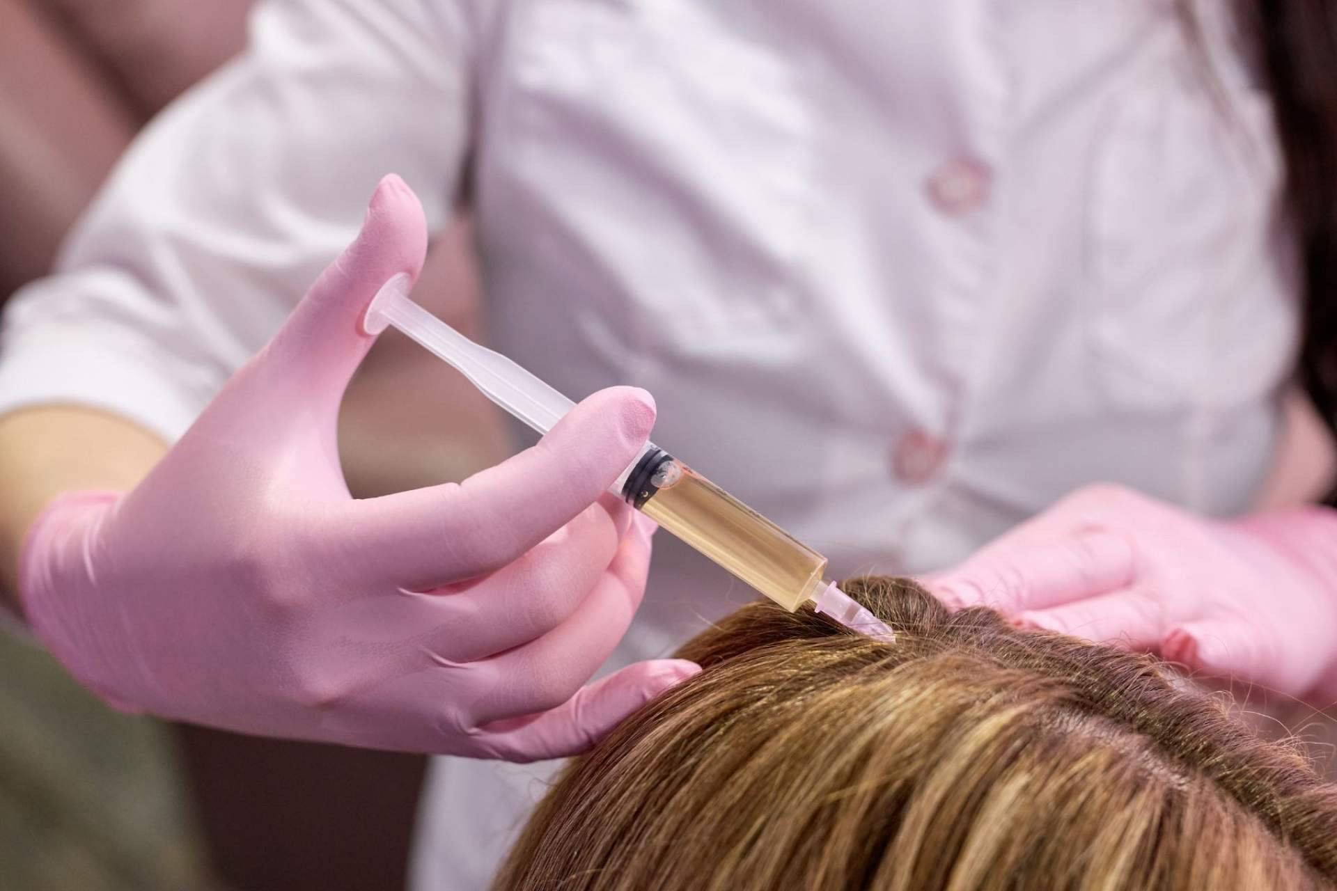  Tratamiento de mesoterapia capilar con fármacos para combatir la alopecia femenina y masculina 