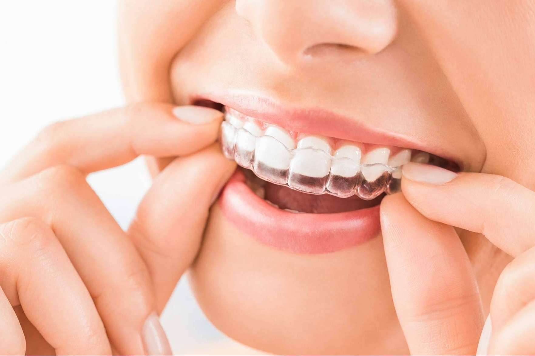  Ortodoncia 3D y blanqueamiento gratis, solo el 23 de mayo en Clínicas Nobel 