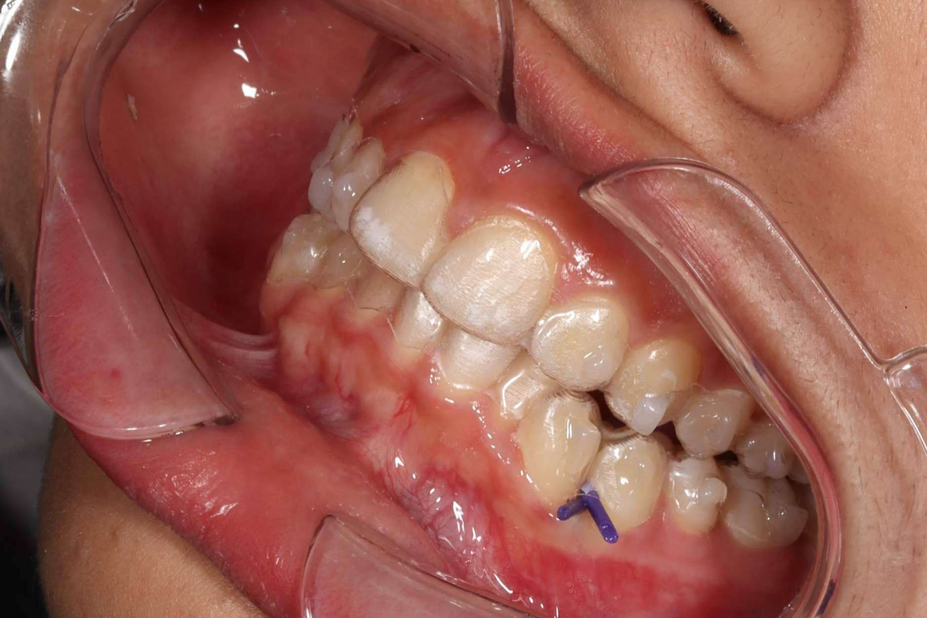  El 56% de las personas tienen miedo a ponerse ortodoncia 