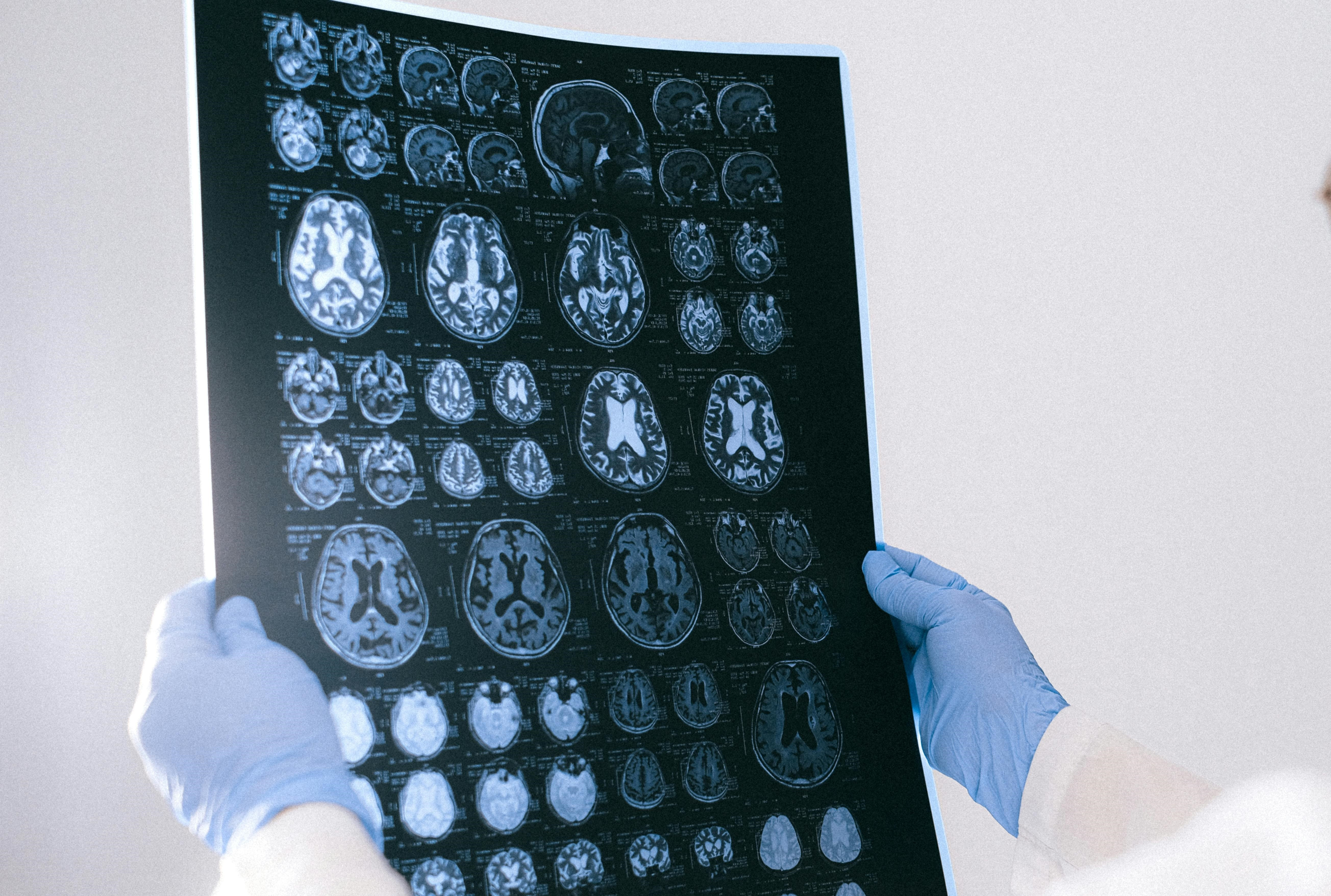  ​El flujo sanguíneo del cerebro disminuye en etapas asintomáticas del Alzheimer 