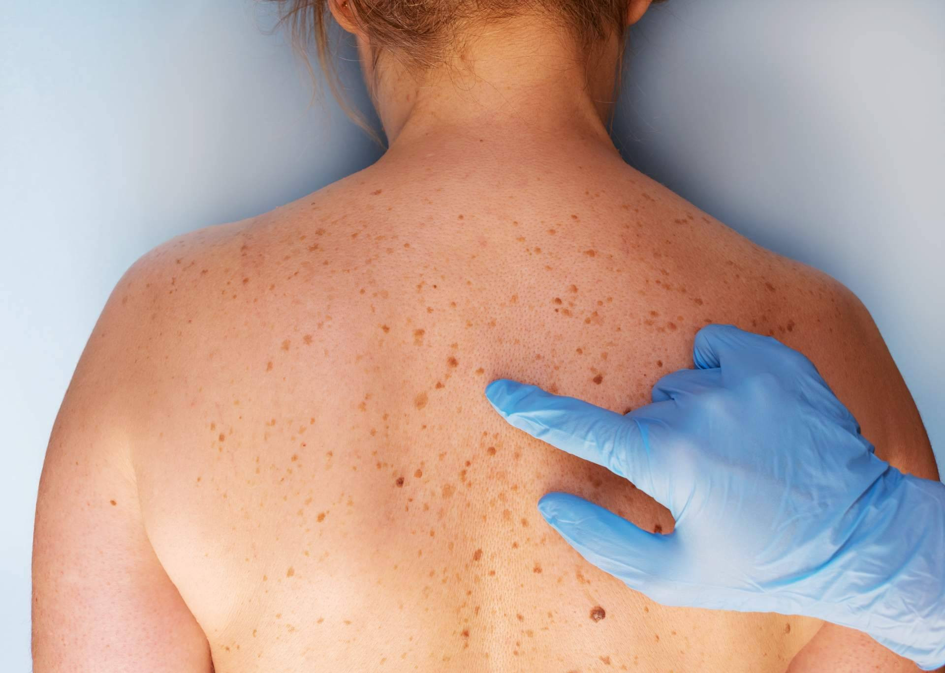  Eliminar las manchas en la piel, con los tratamientos del Centro Estética el Pilar 