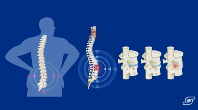 VIdeo espondiloartritis