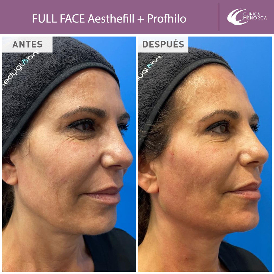 FULL FACE Aesthefill   Profhilo 1