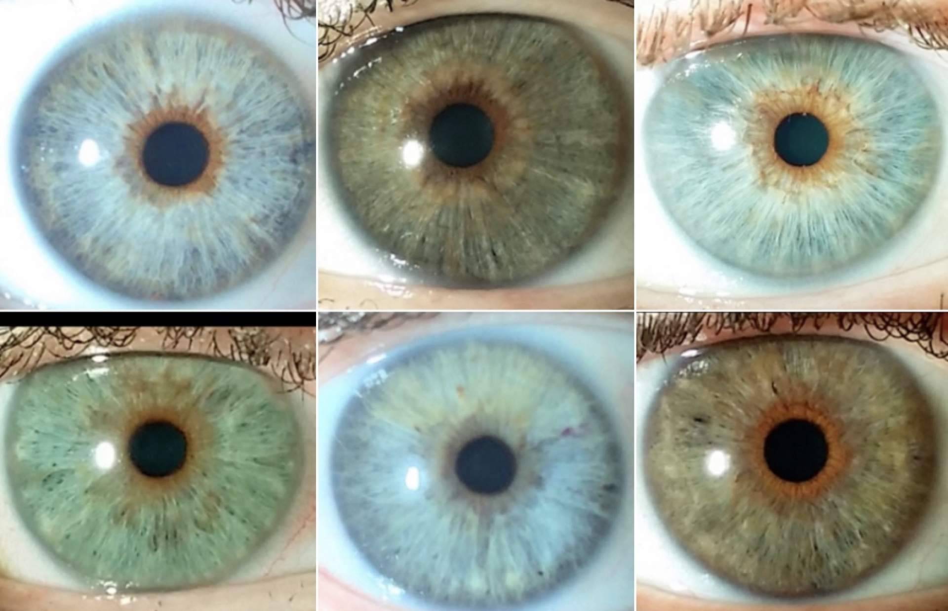 Rostos e Vídeos - Clínica Eyecos - Cambio color de ojos